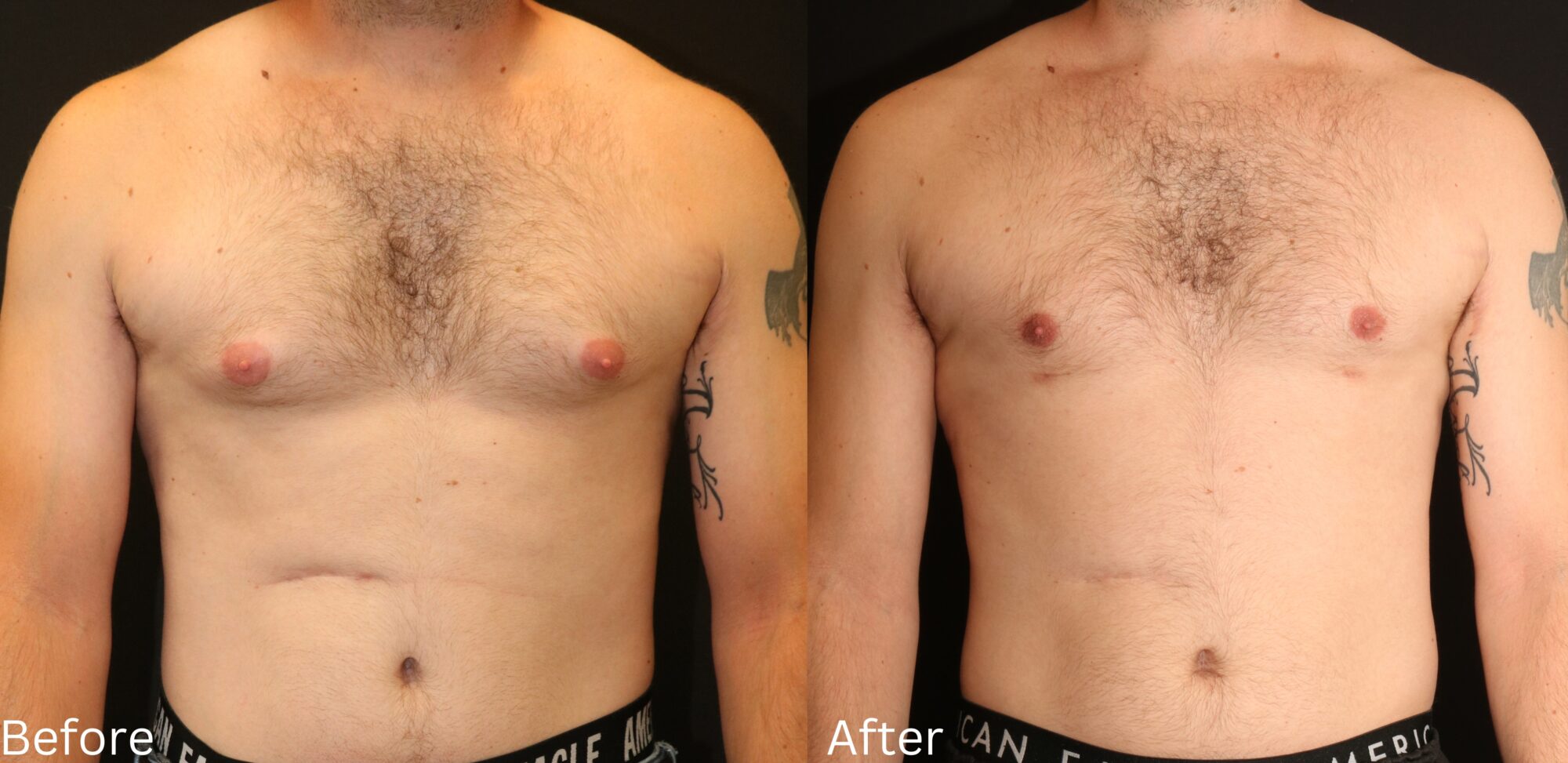 Indianapolis gynecomastia chernoff