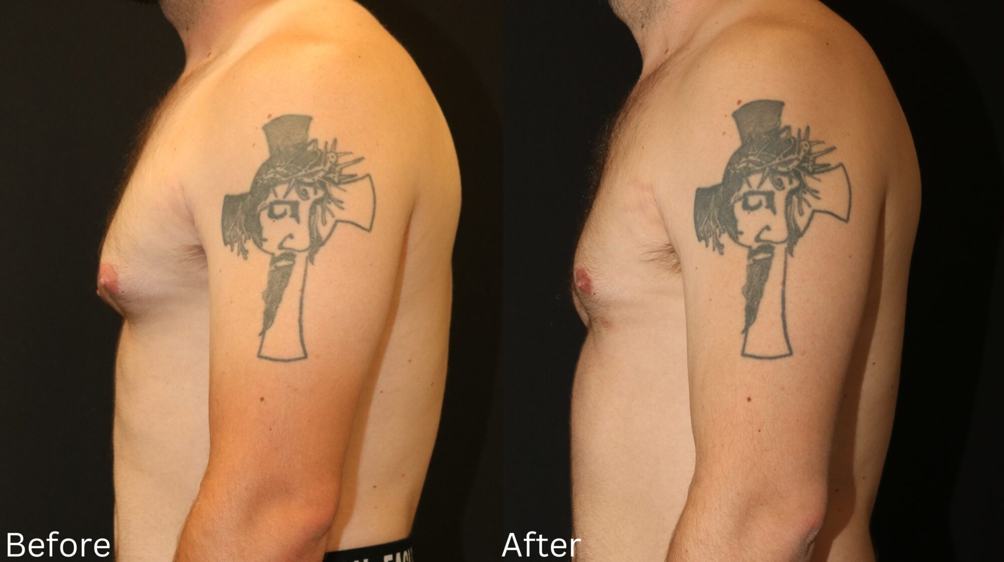Indianapolis gynecomastia chernoff