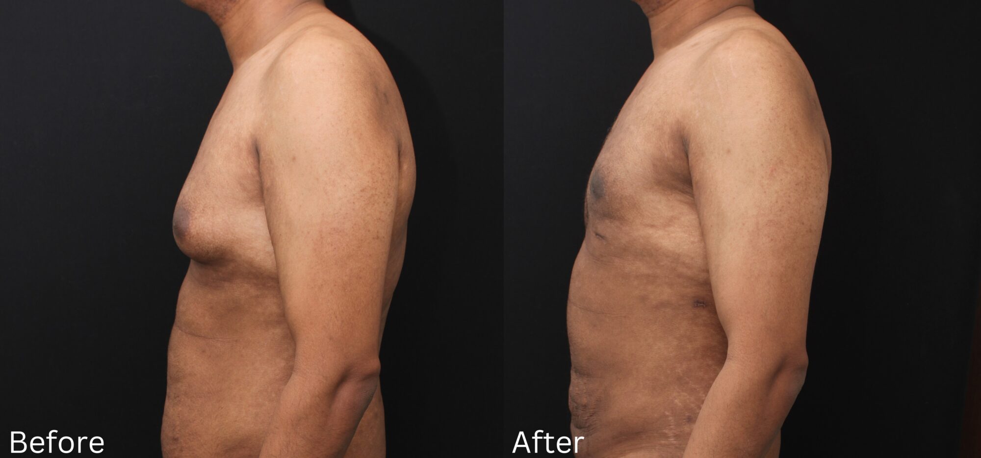 Indianapolis gynecomastia chernoff