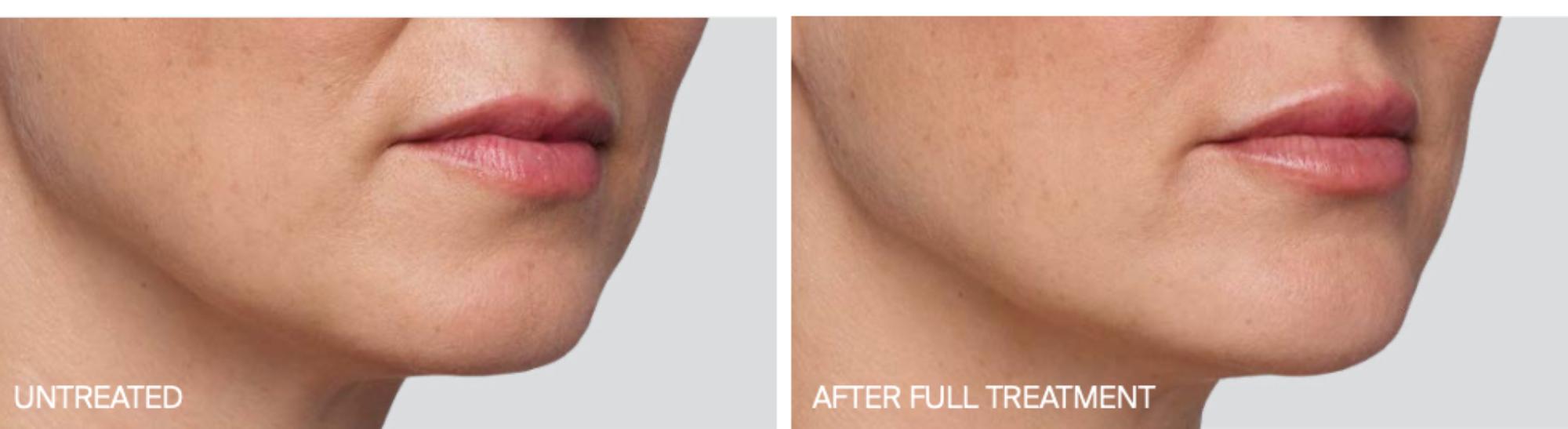 Indianapolis Juvederm Chernoff