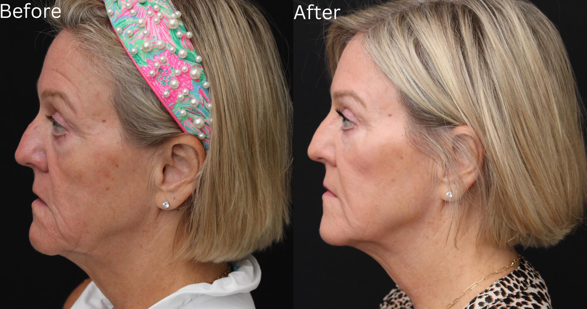 Indianapolis Juvederm Chernoff