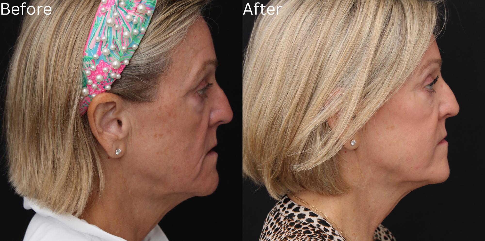 Indianapolis Juvederm Chernoff