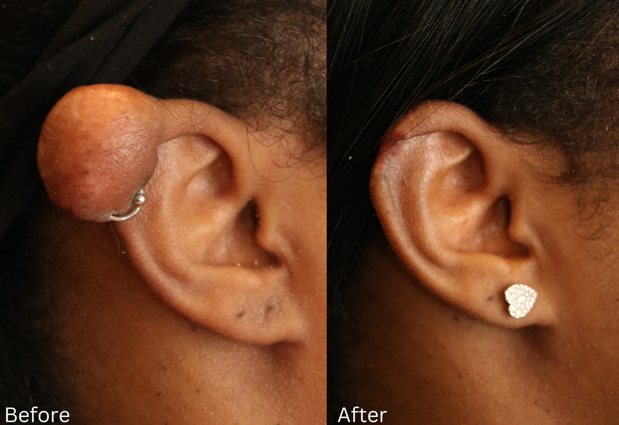 Indianapolis keloid removal chernoff