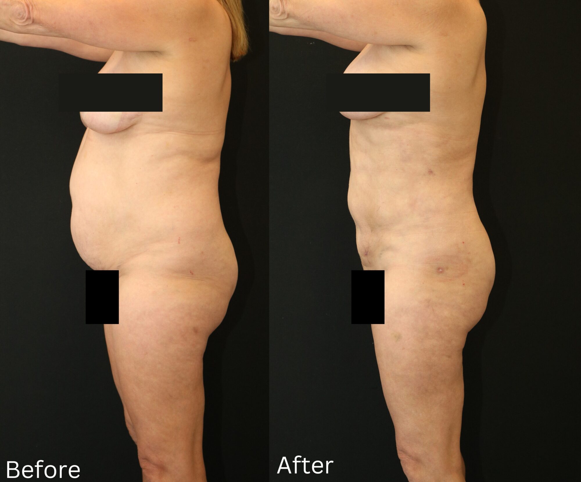 Indianapolis liposuction chernoff