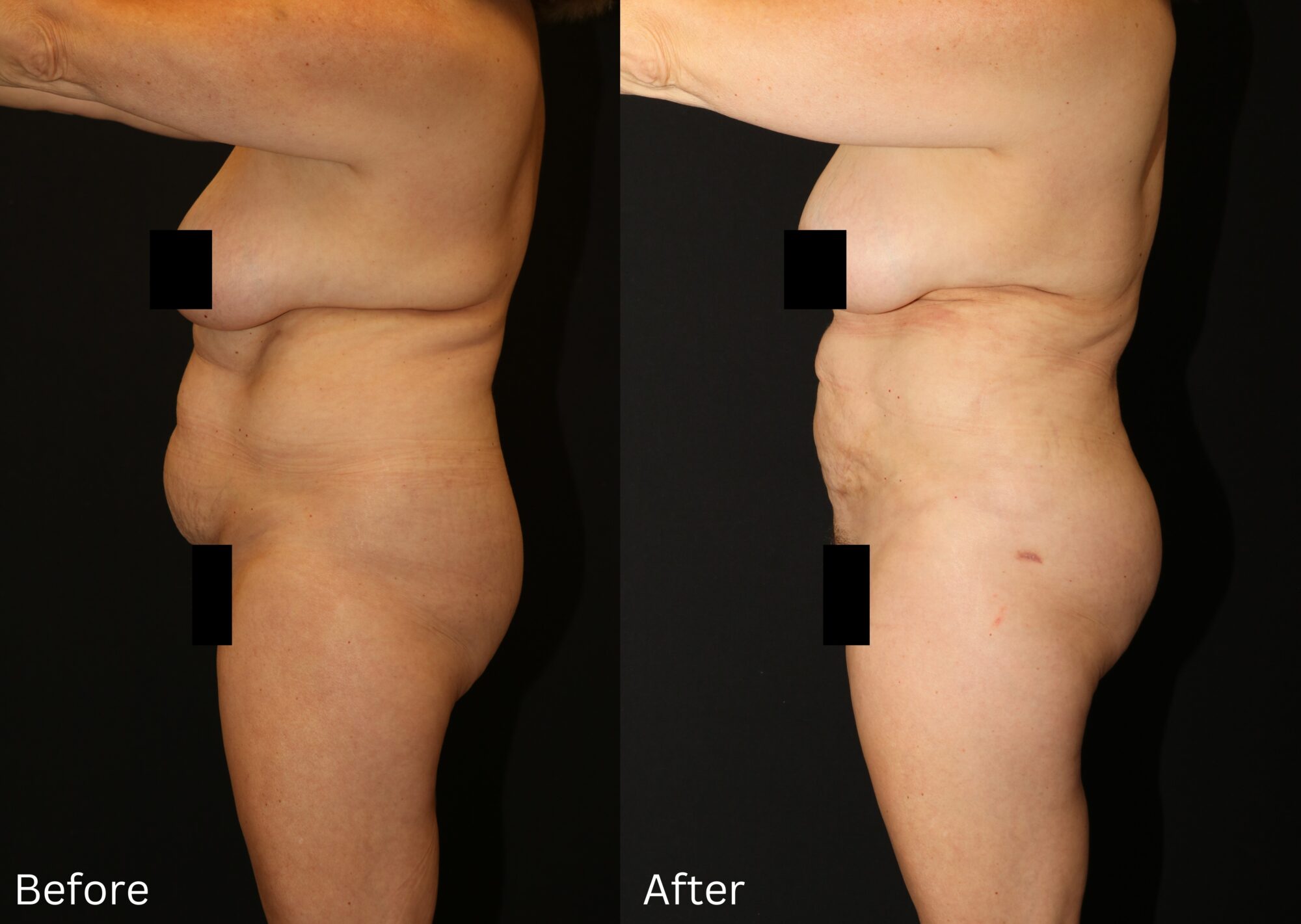 Indianapolis liposuction chernoff