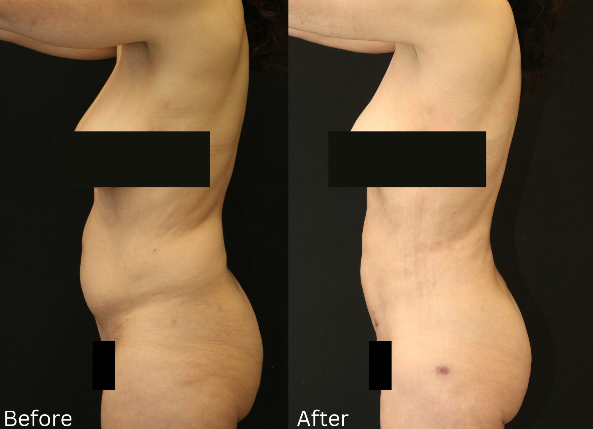 Indianapolis liposuction chernoff