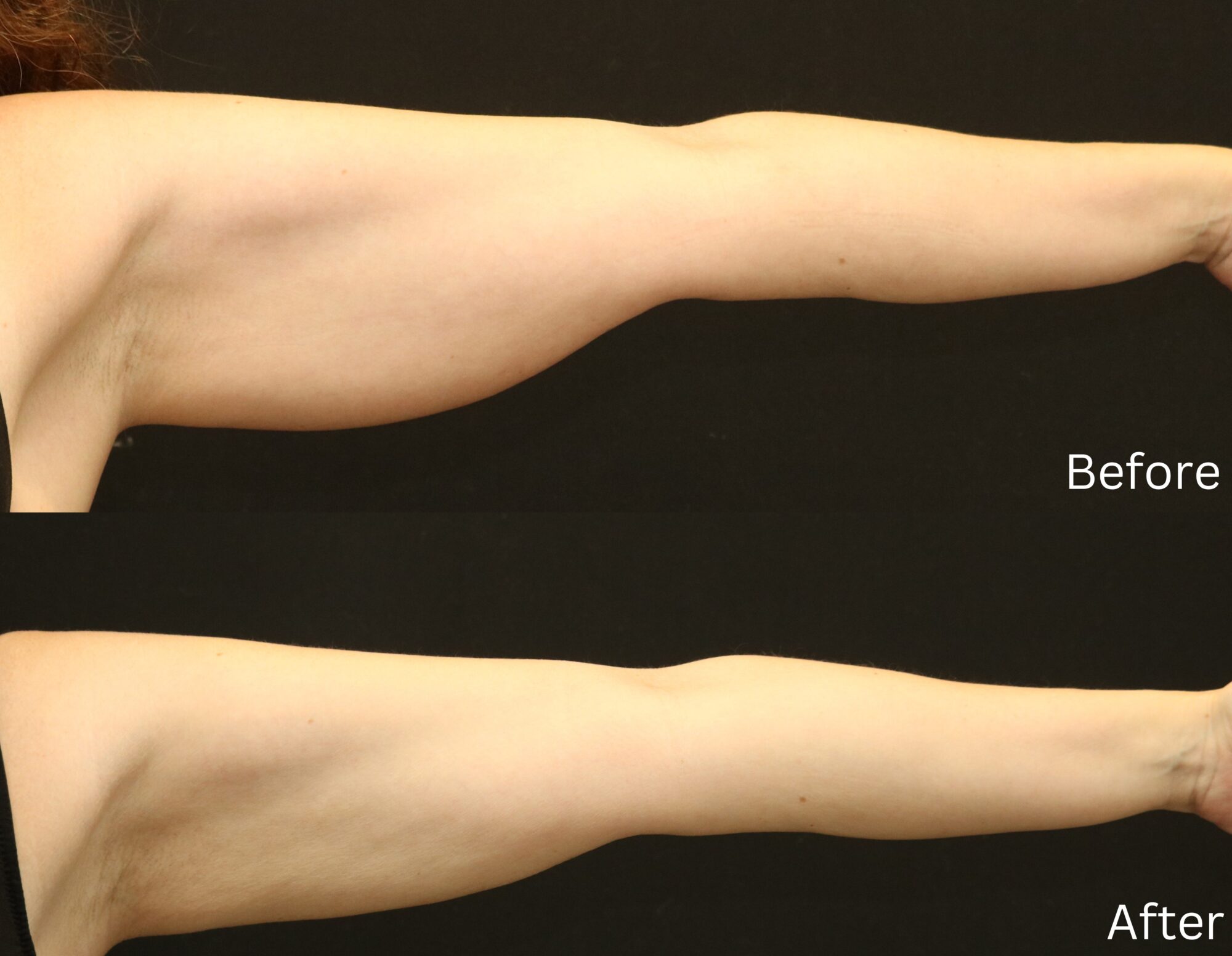 Indianapolis liposuction chernoff