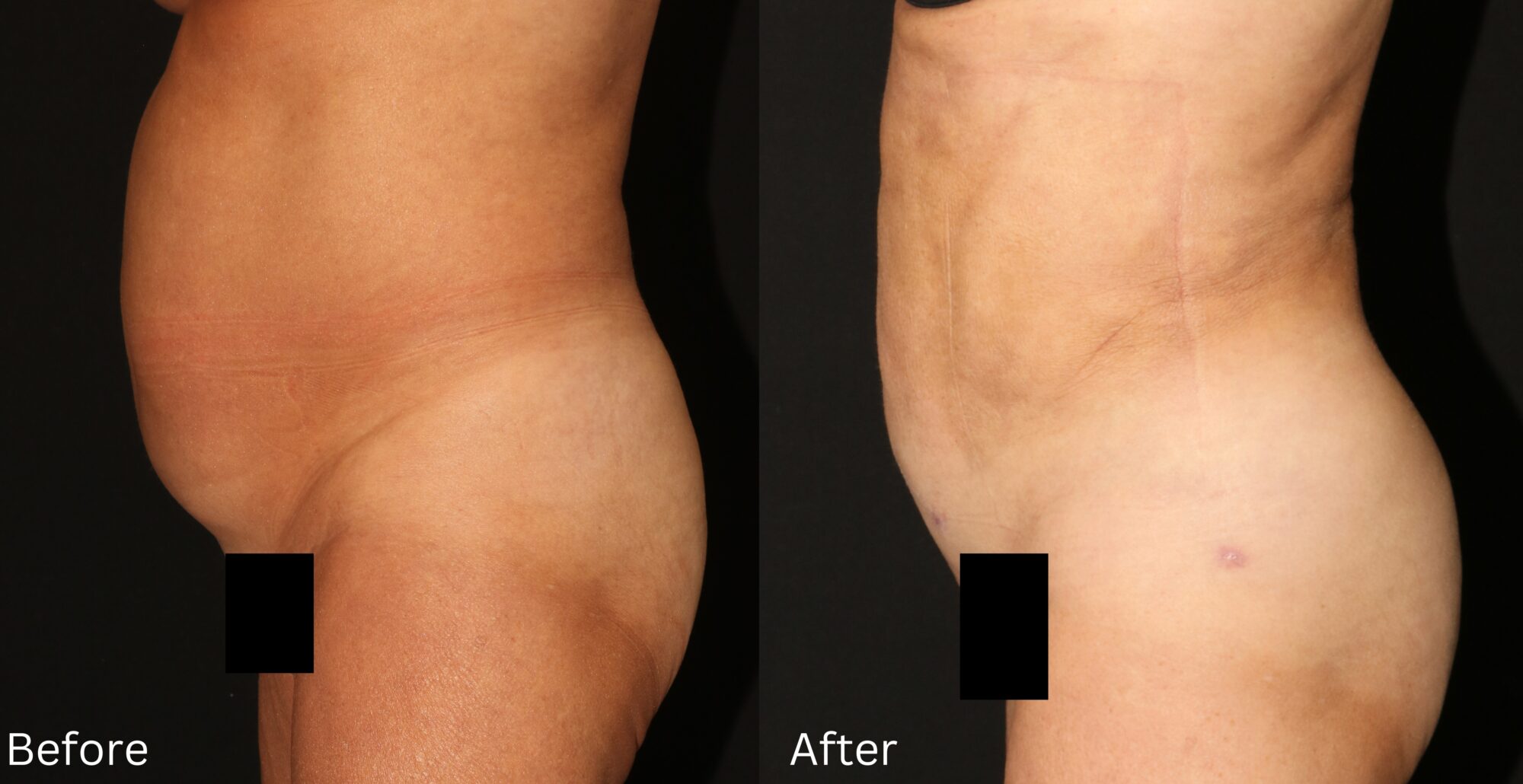 Indianapolis liposuction chernoff