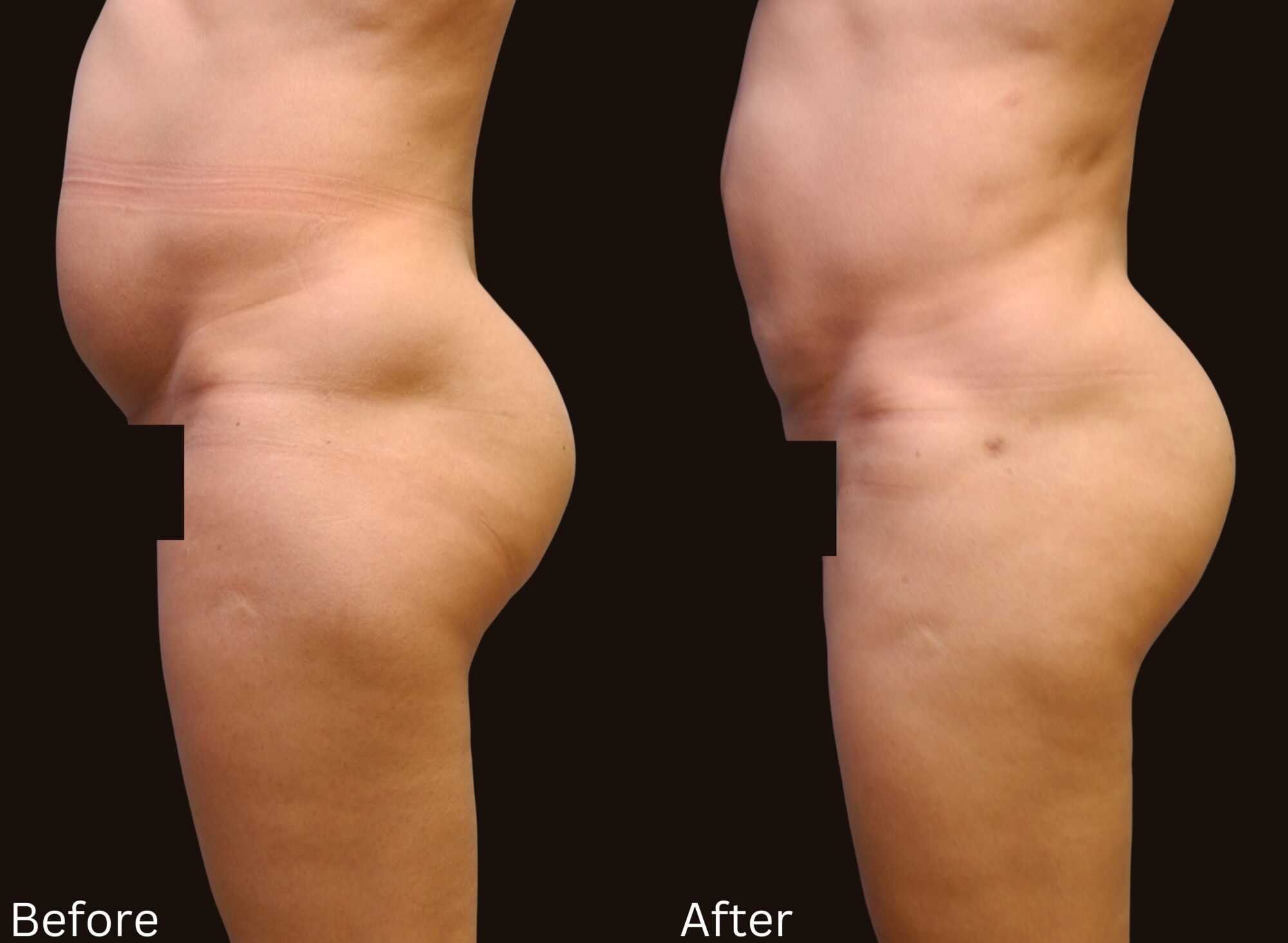 Indianapolis liposuction chernoff