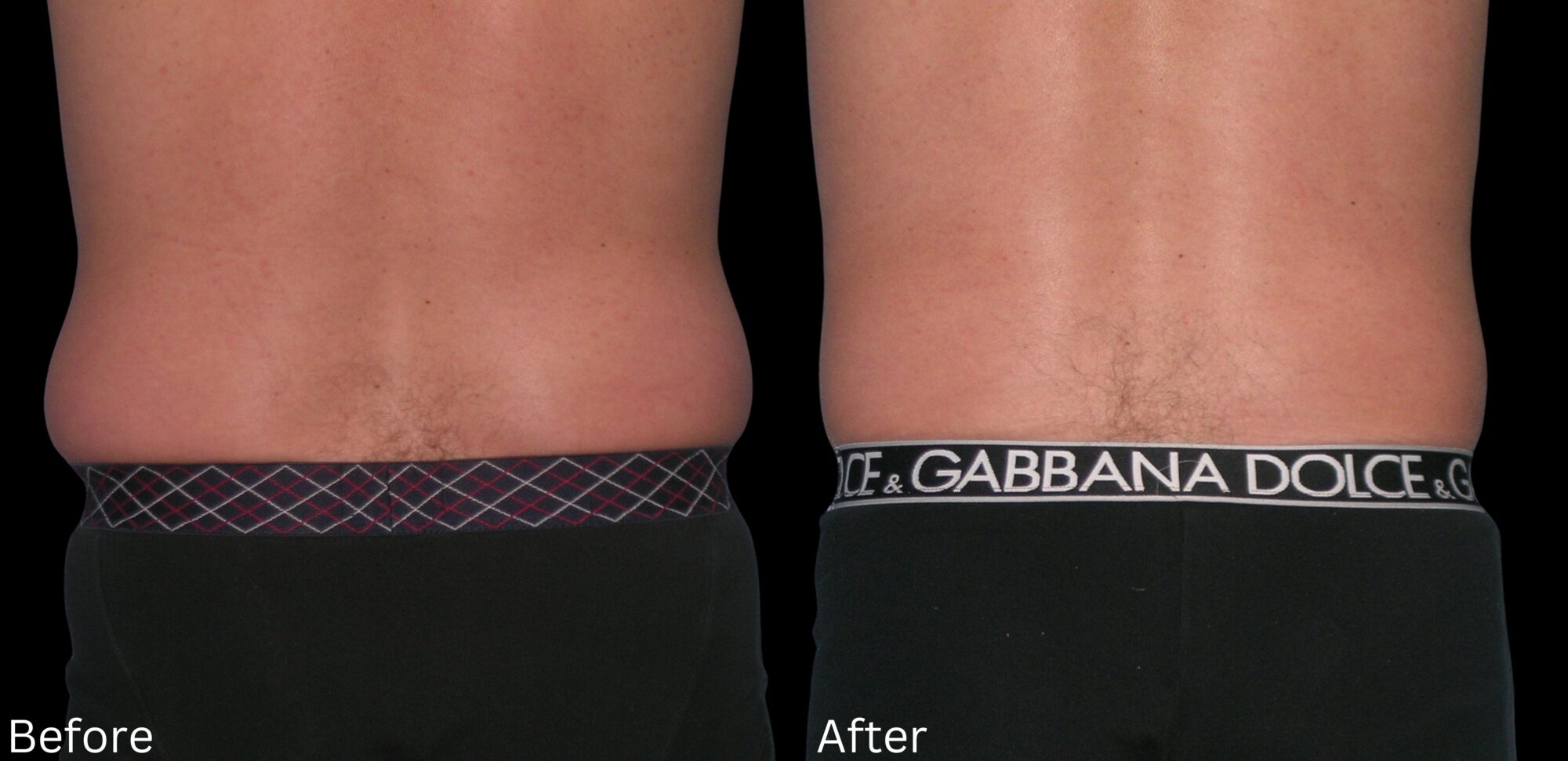Indianapolis liposuction chernoff