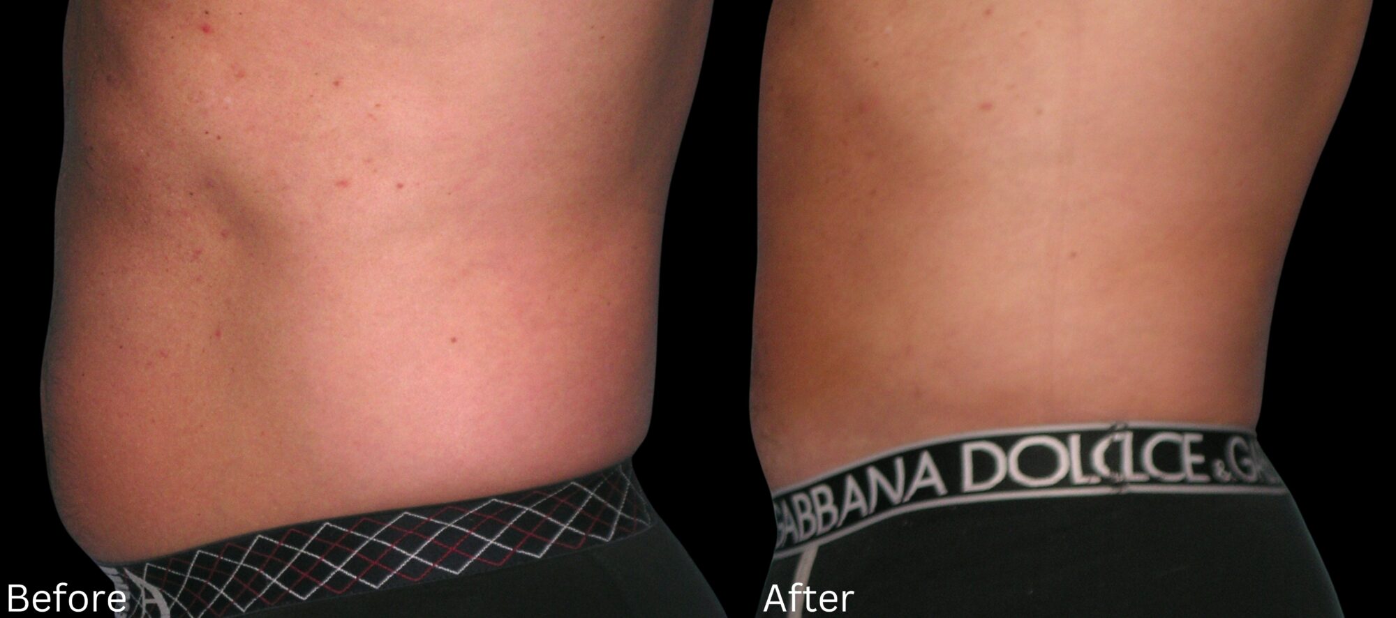 Indianapolis liposuction chernoff
