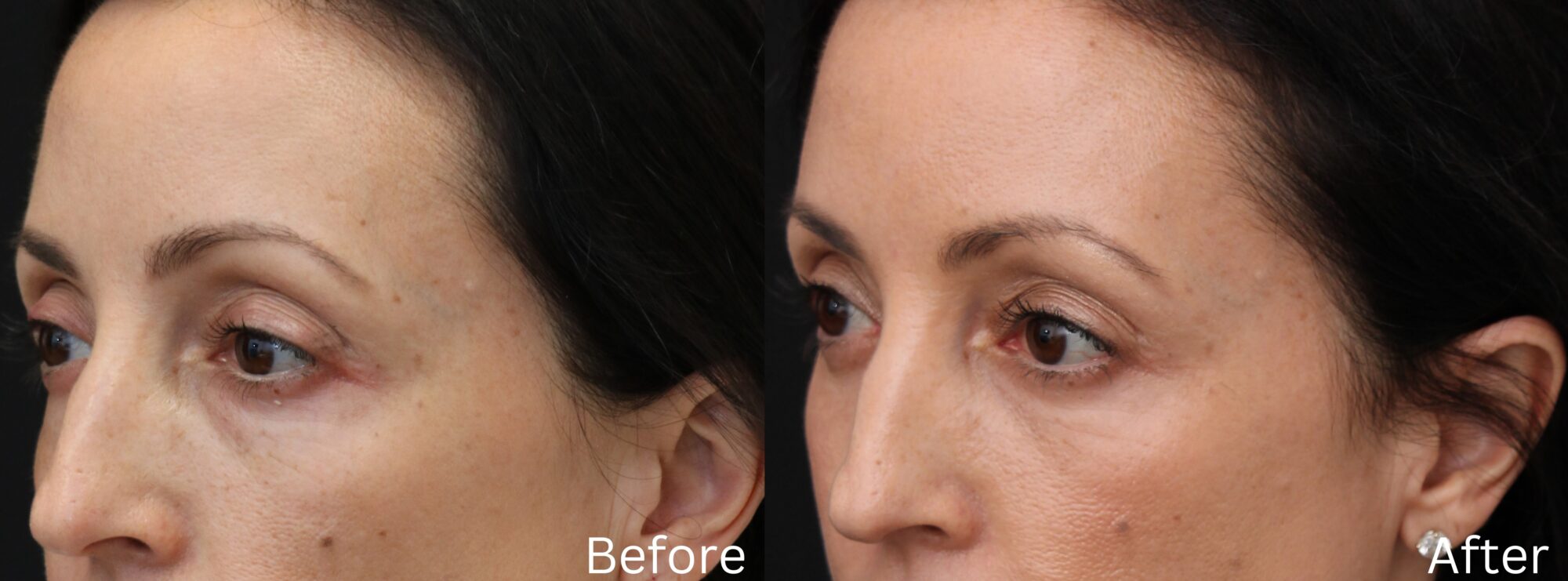 Indianapolis eyelid lift chernoff