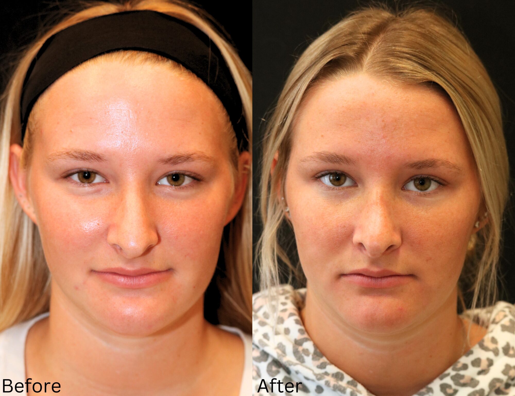 Indianapolis rhinoplasty chernoff