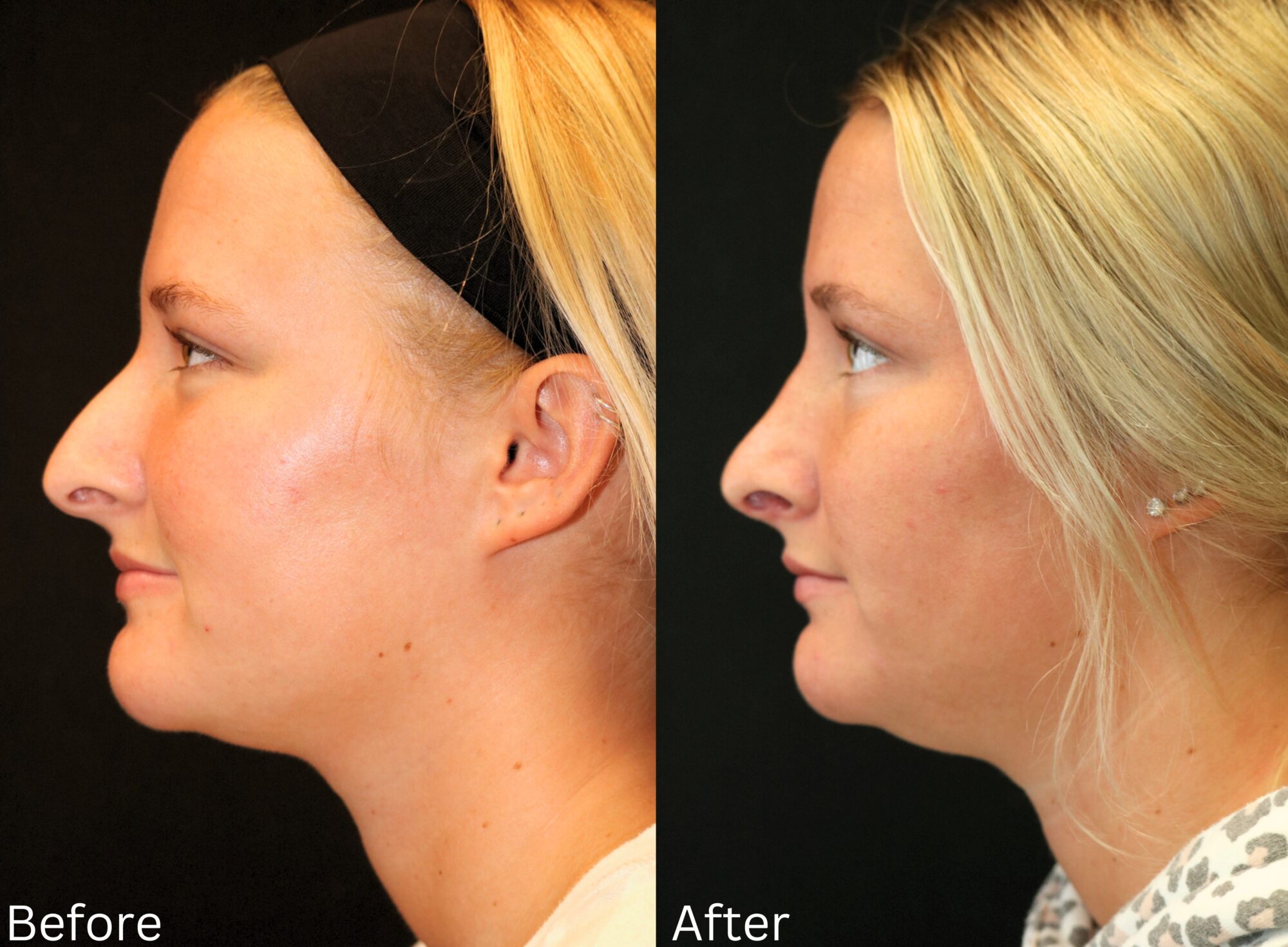 Indianapolis rhinoplasty chernoff
