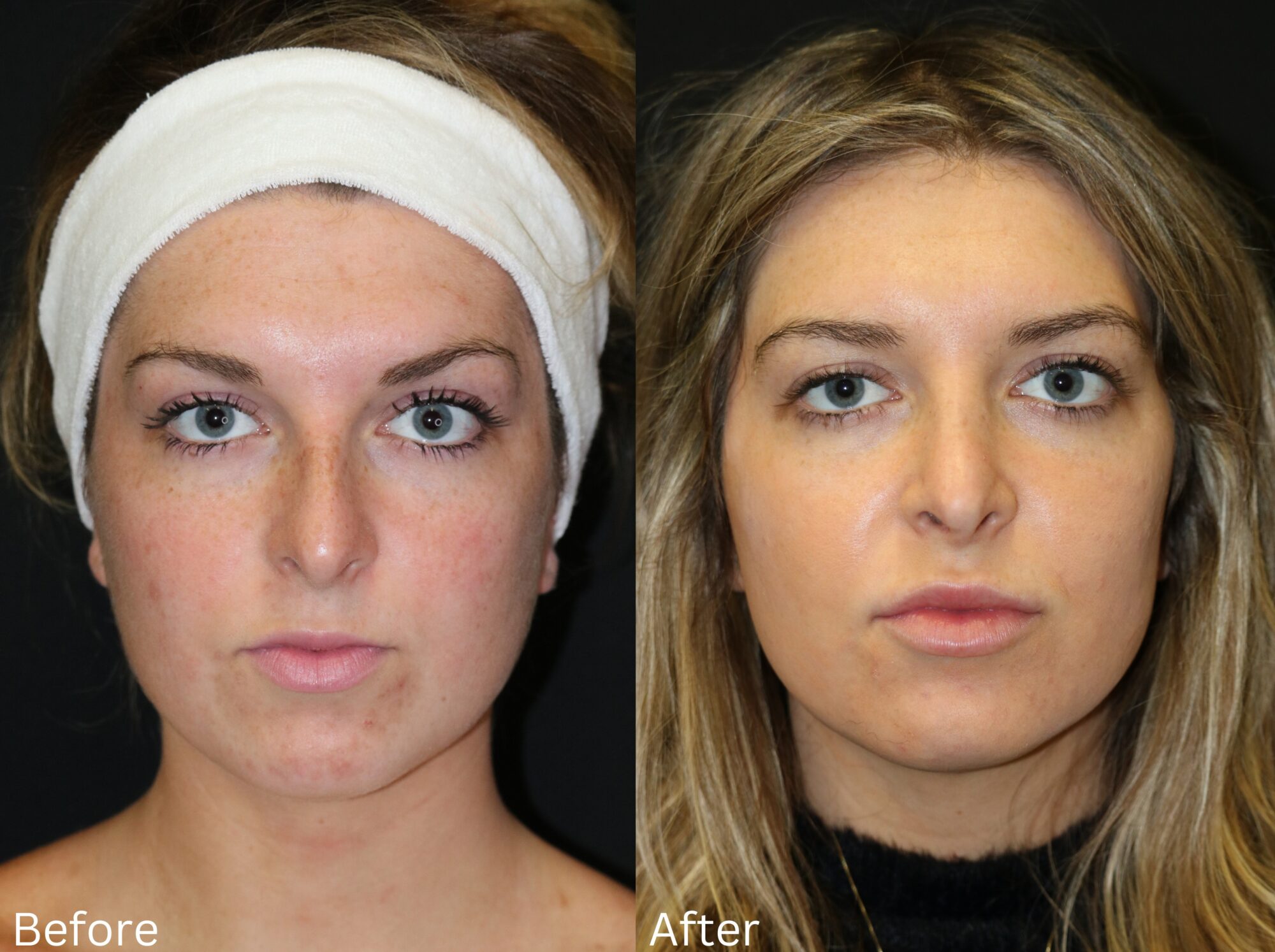 Indianapolis rhinoplasty chernoff