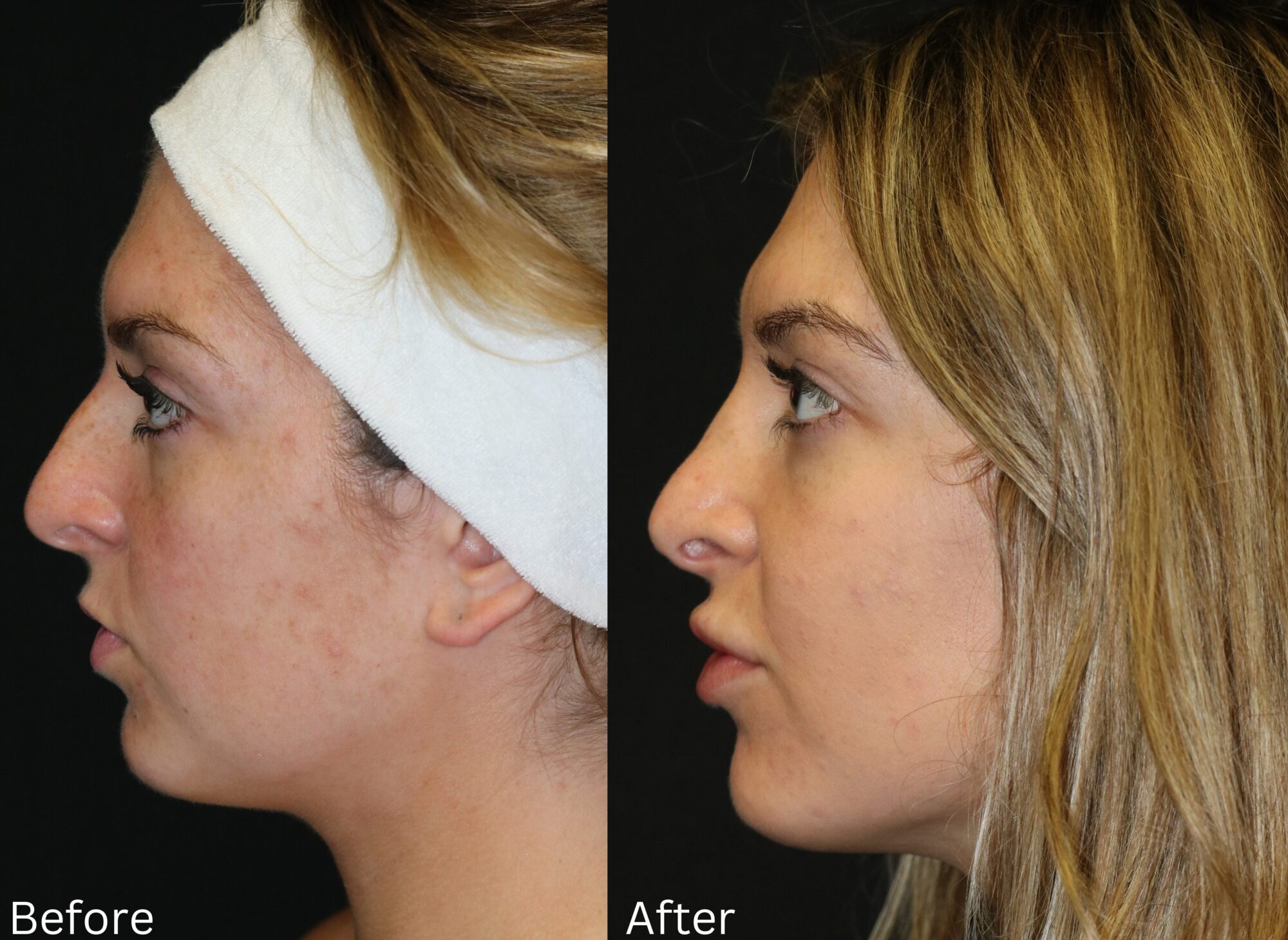 Indianapolis rhinoplasty chernoff