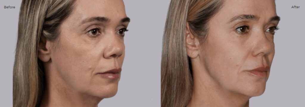 Sculptra2