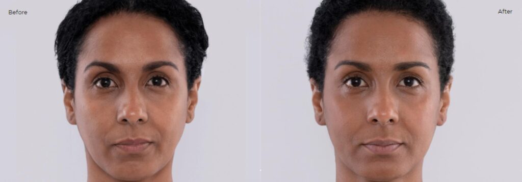 Sculptra4