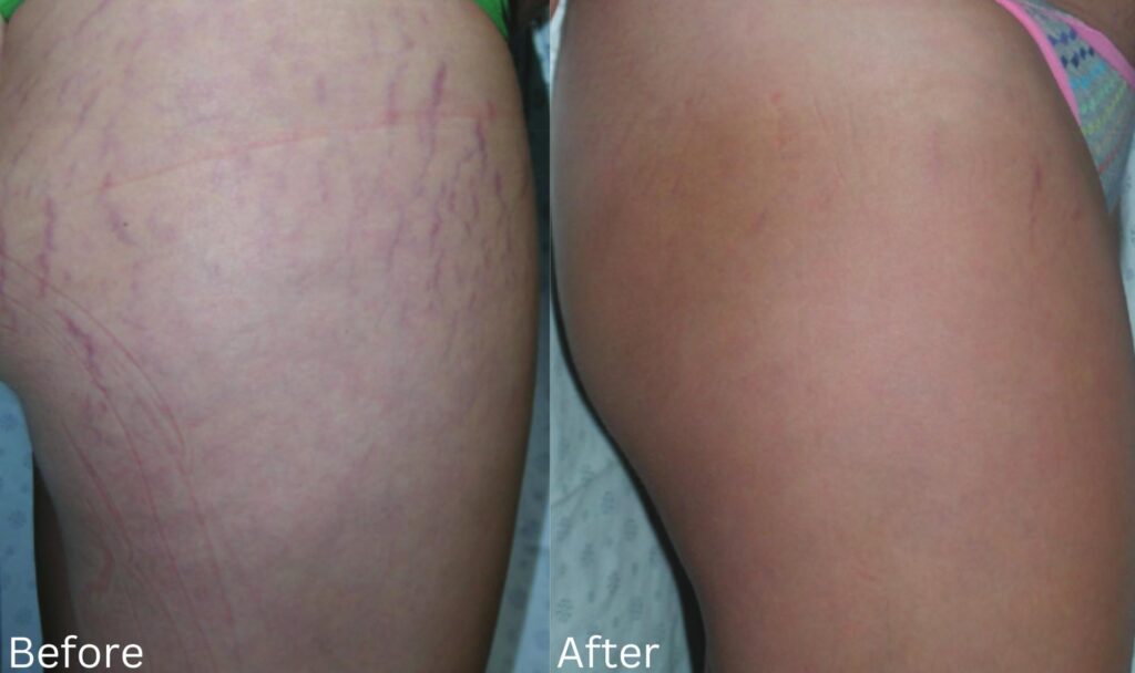 Stretchmarks1 (1)