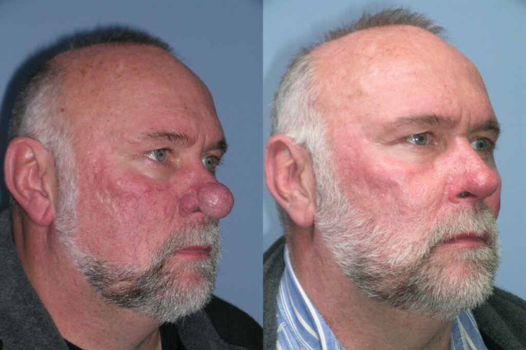 Rhinophyma-ba-3