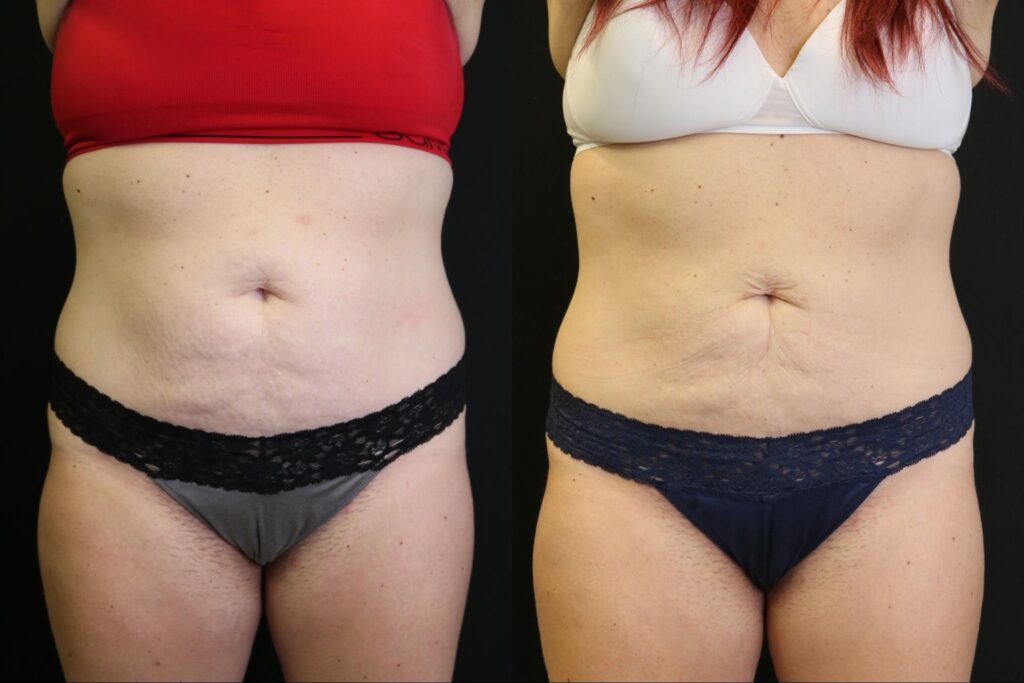 3 Exilis & 3 CoolSculpting Treatments