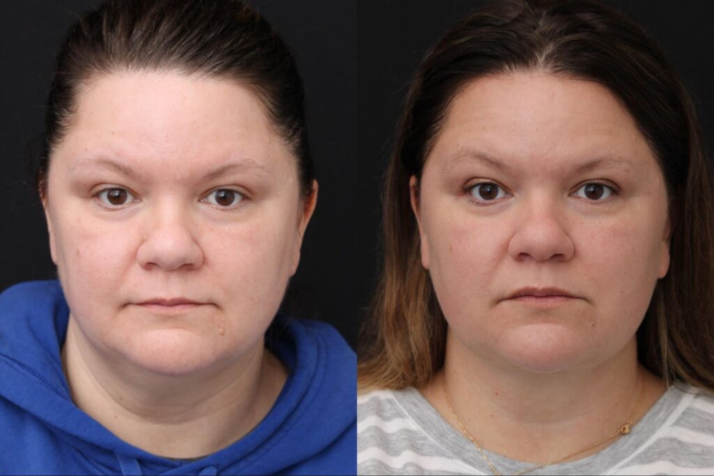 Ellevate with short scar and buccal fat