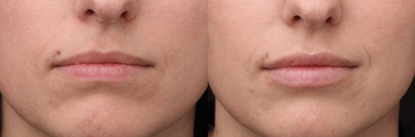 Lip Filler (Redensity)
