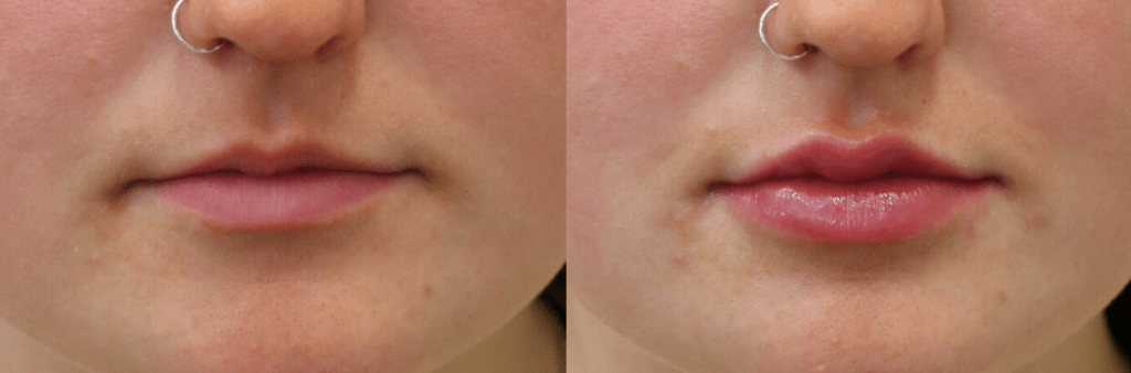 Lip Filler – Volbella