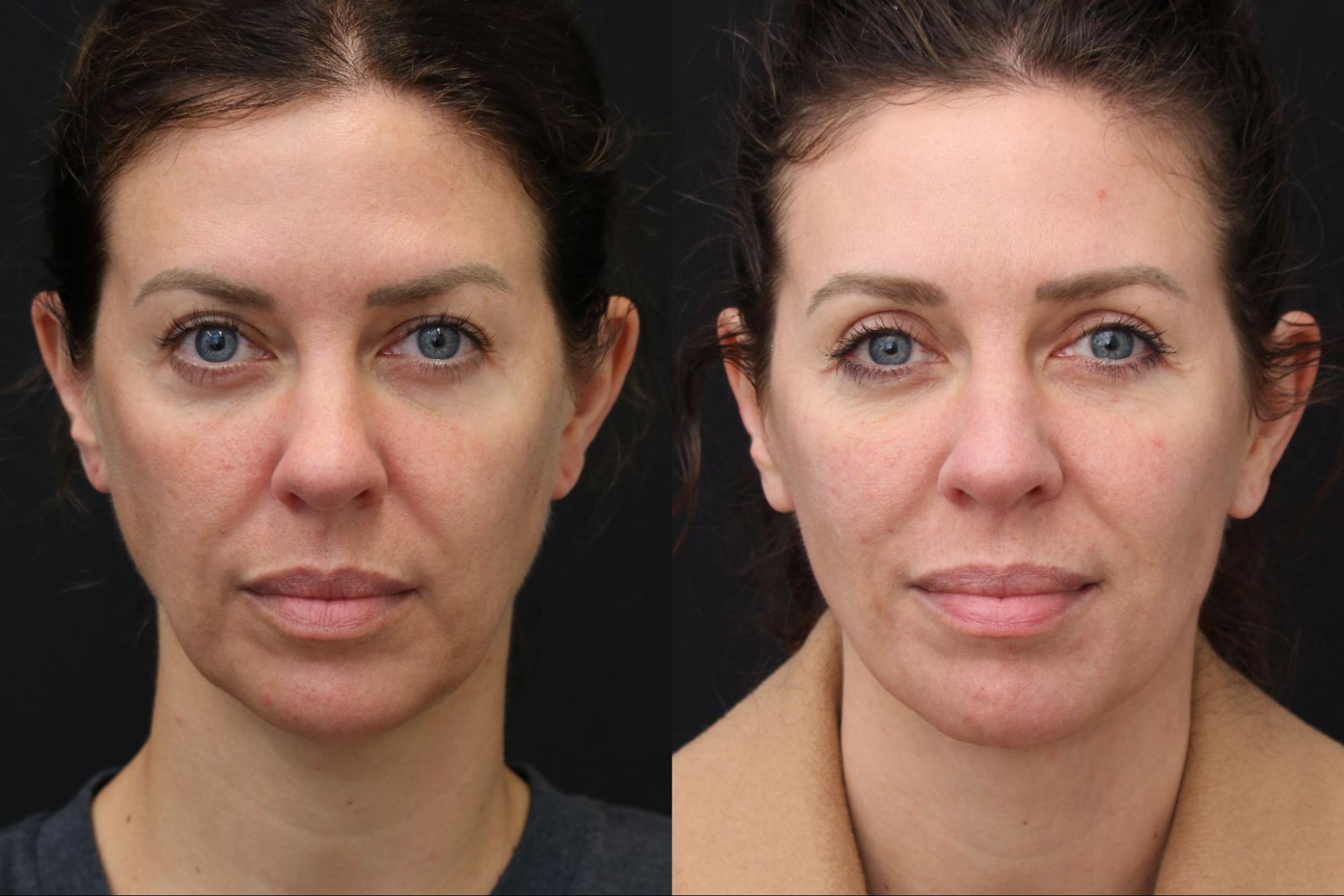 Face/Neck lift and Upper Bleph