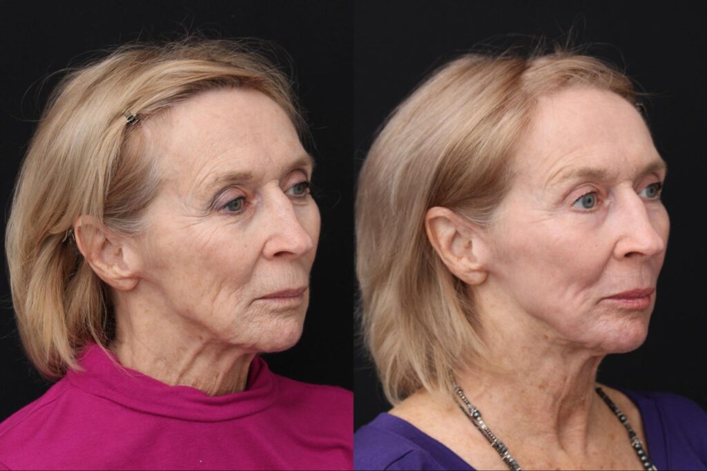 CO2 laser resurfacing