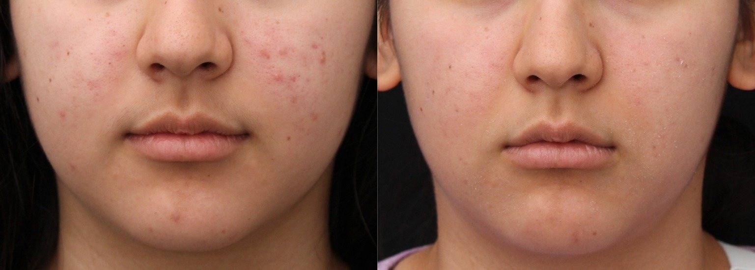 close-up of device applicators for Indianapolis body contouring