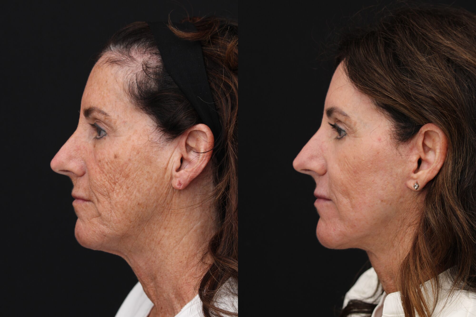 noninvasive contouring device used for body sculpting Indianapolis
