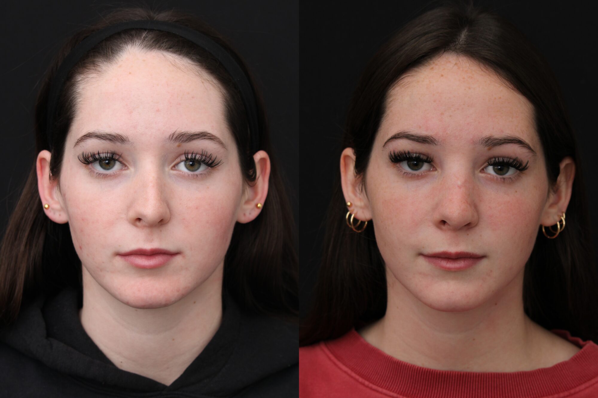infographic comparing procedures and Indianapolis plastic surgery cost